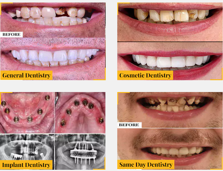 dental implant